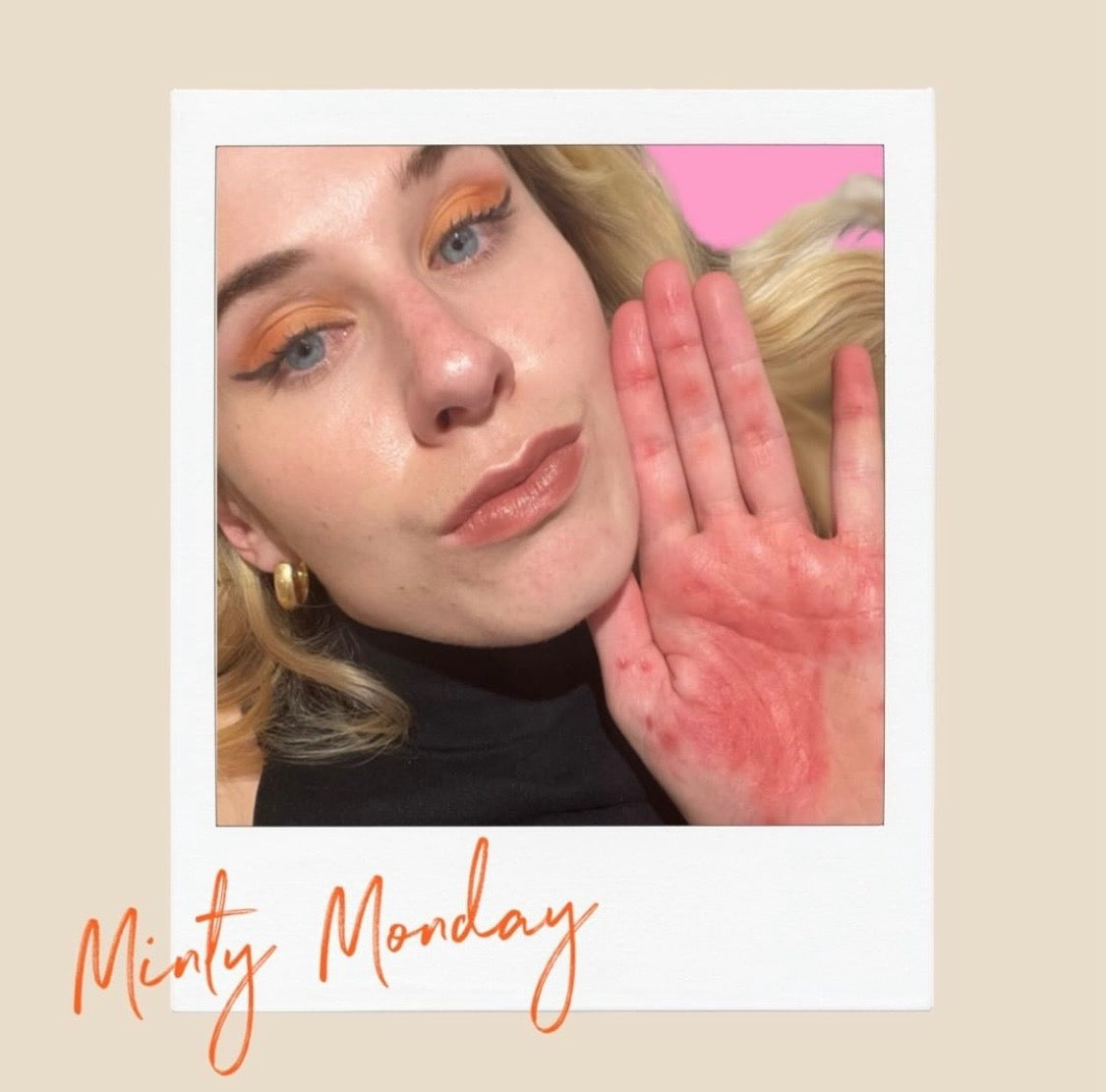 Minty + Feature with Eczema Warrior, Katie